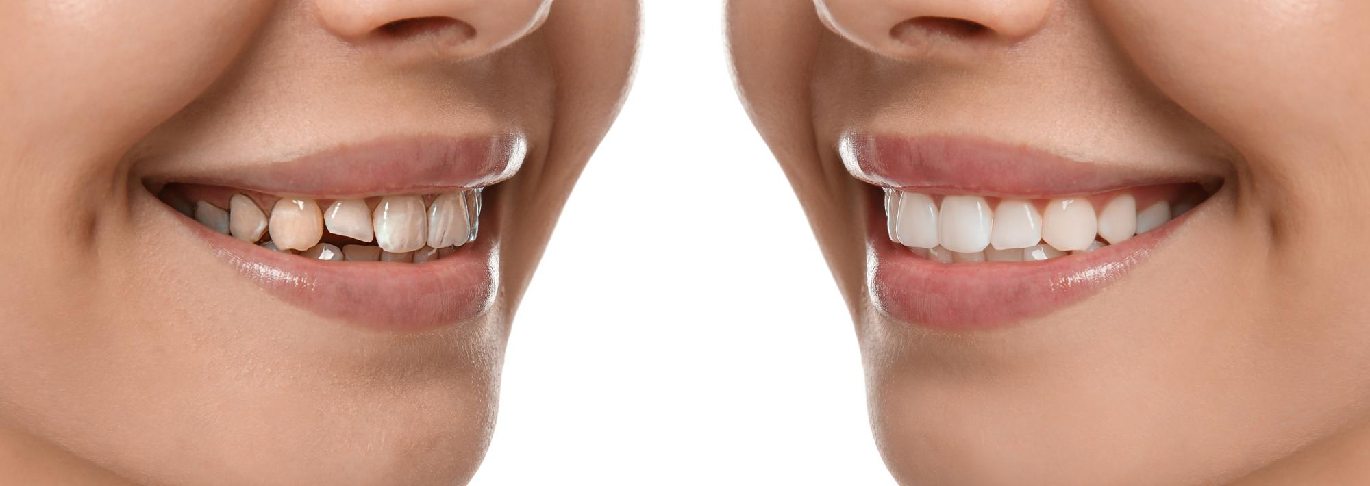 Smile Designing Before & After